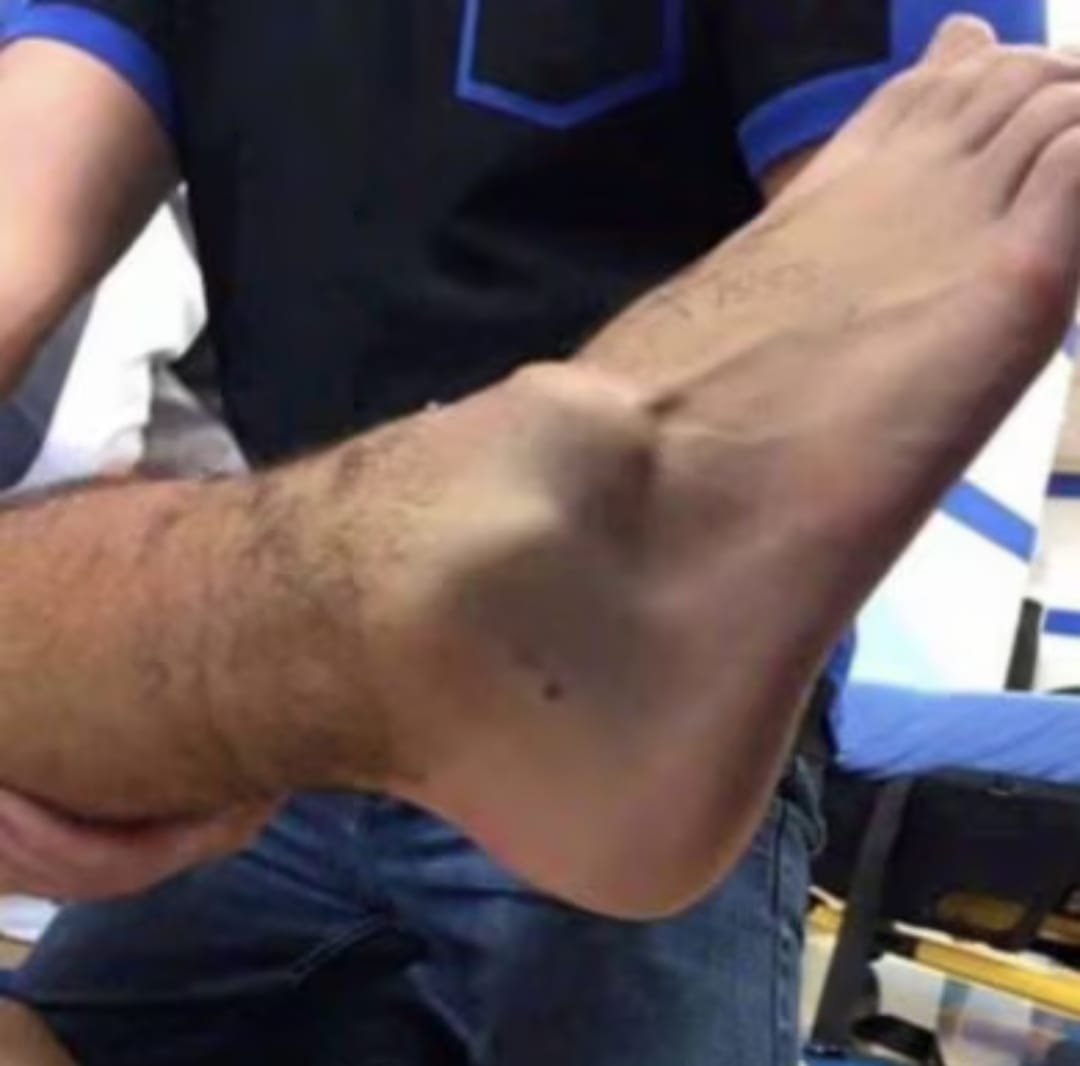 Hakimi infortunio choc: Luis Diaz lo stende, la caviglia si gonfia subito